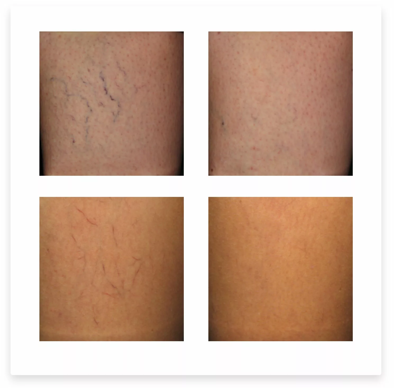 Spider vein treatment with Aesclera at SANTÉ Aesthetics & Wellnes in Portland, Oregon BEFORE & AFTER PHOTOS