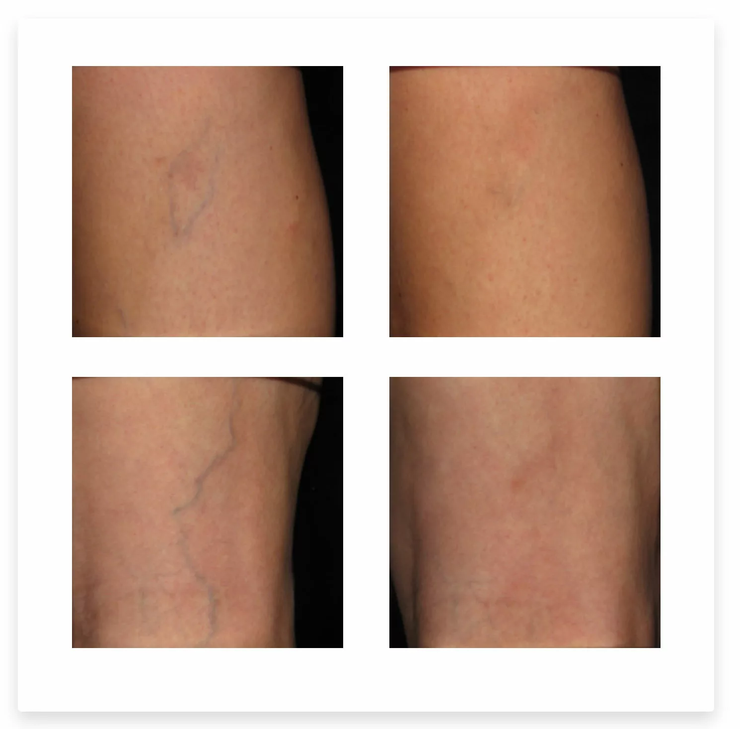 Spider vein treatment with Aesclera at SANTÉ Aesthetics & Wellnes in Portland, Oregon BEFORE & AFTER PHOTO