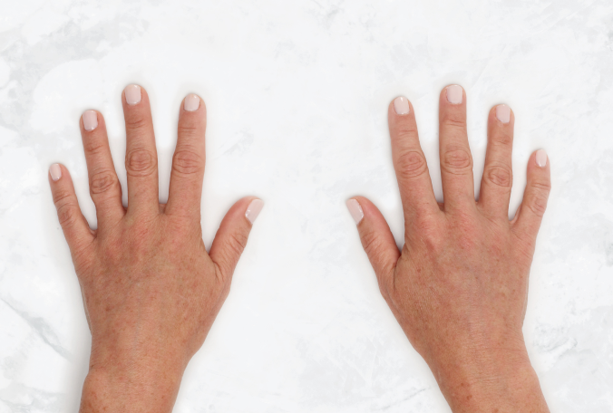 Claire was treated with 3 mL Restylane Lyft per hand.