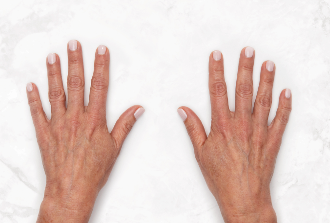 Claire was treated with 3 mL Restylane Lyft per hand.