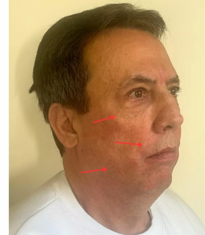 After image of natural facial treatment around eyes, mouth, and cheek Cellenis® DermaFiller Derma PRP at SANTÉ Aesthetics & Wellness in Portland, Oregon