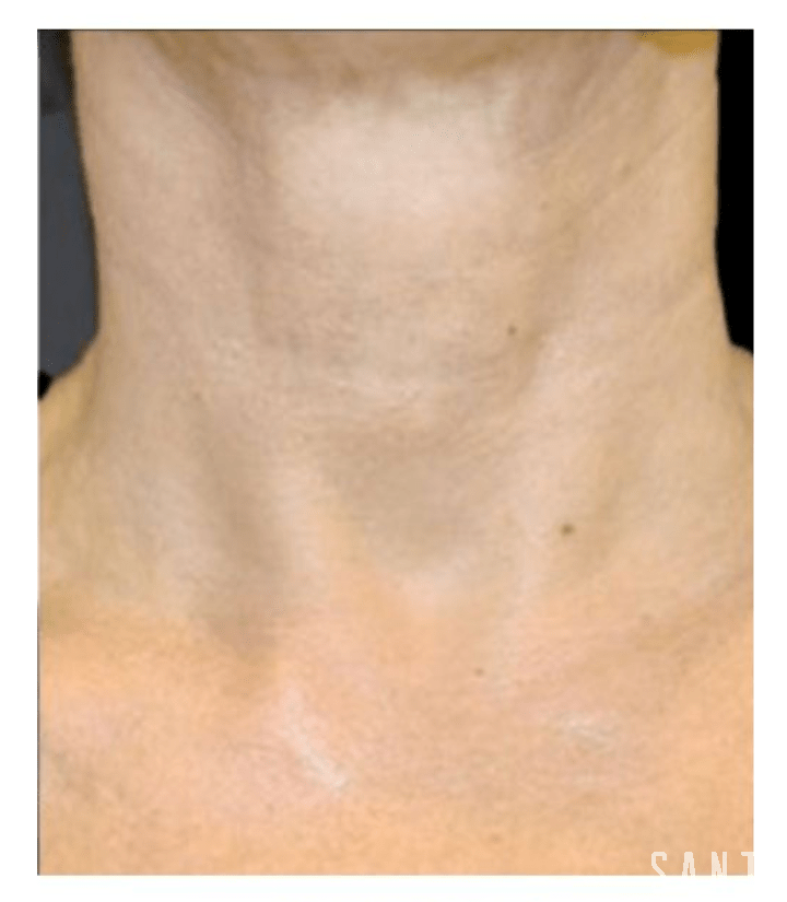 After image of natural neck treatment using Derma PRP at SANTÉ Aesthetics & Wellness in Portland, Oregon