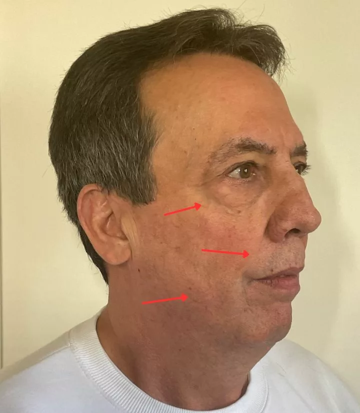 Before image of natural facial treatment around eyes, mouth, and cheek Cellenis® DermaFiller Derma PRP at SANTÉ Aesthetics & Wellness in Portland, Oregon