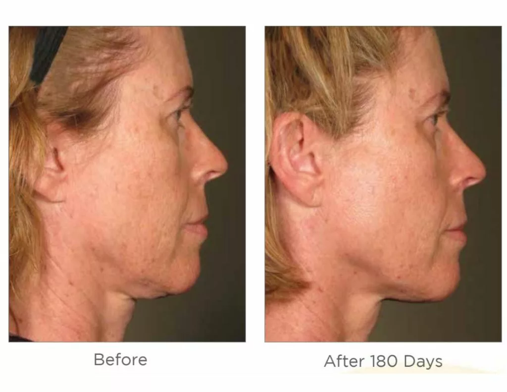 Ultherapy before and after images-face. SANTÉ Aesthetics & Wellness in Portland, Oregon