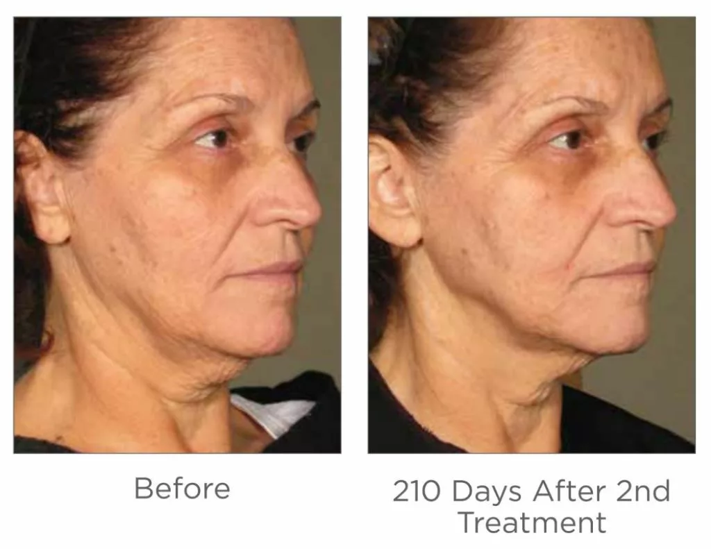 Ultherapy before and after images-face. SANTÉ Aesthetics & Wellness in Portland, Oregon