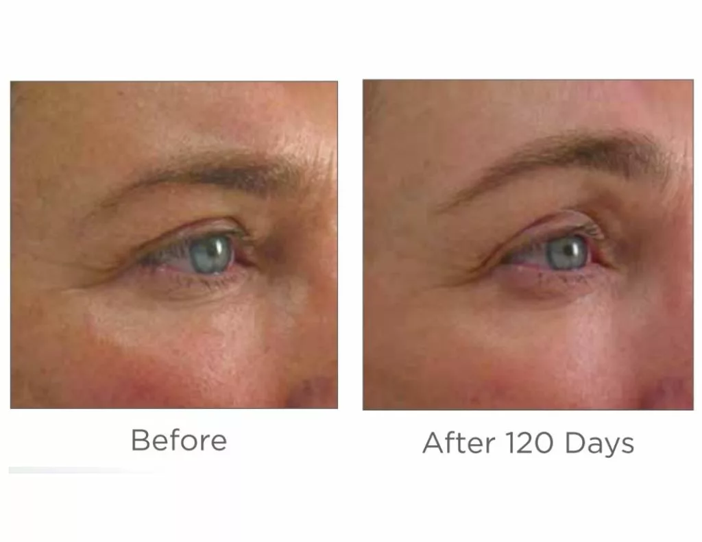 Ultherapy before and after images-brow. SANTÉ Aesthetics & Wellness in Portland, Oregon