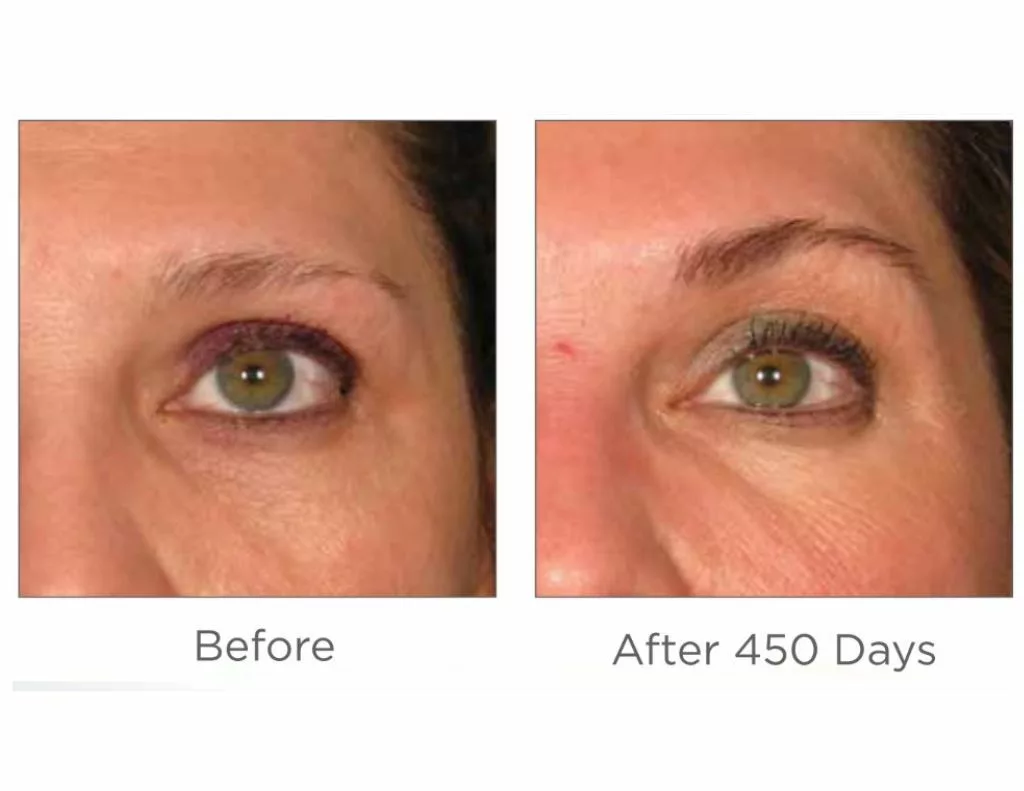 Ultherapy before and after images-brow. SANTÉ Aesthetics & Wellness in Portland, Oregon