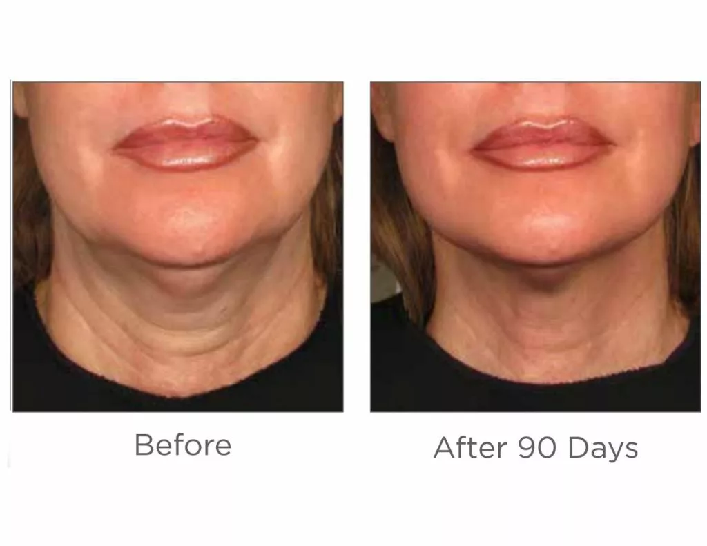 Ultherapy before and after images-chin. SANTÉ Aesthetics & Wellness in Portland, Oregon