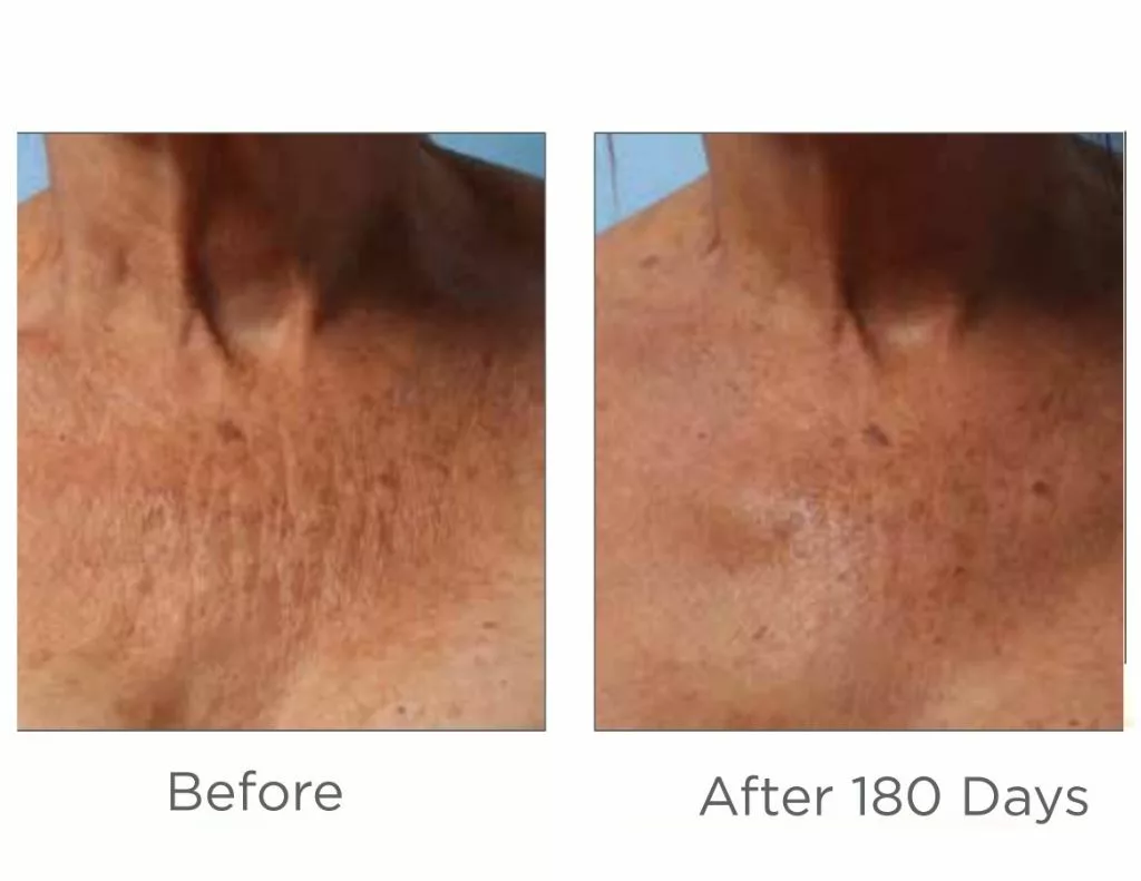 Ultherapy before and after images-decolletage. SANTÉ Aesthetics & Wellness in Portland, Oregon