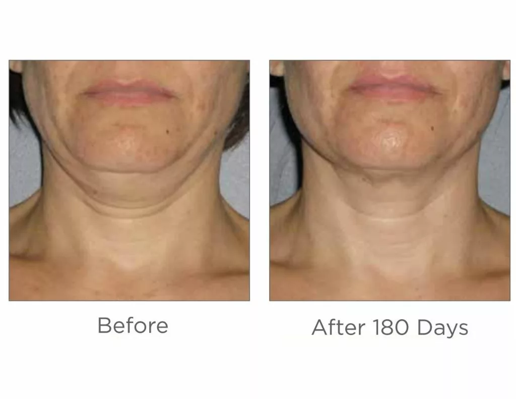 Ultherapy before and after images-neck. SANTÉ Aesthetics & Wellness in Portland, Oregon