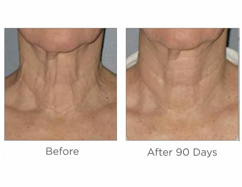 Ultherapy before and after images-neck. SANTÉ Aesthetics & Wellness in Portland, Oregon