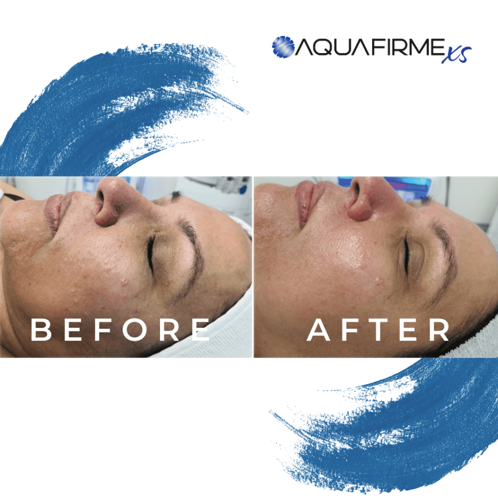 Before and after images using our Aquafirme XS medical facial treatment-image15