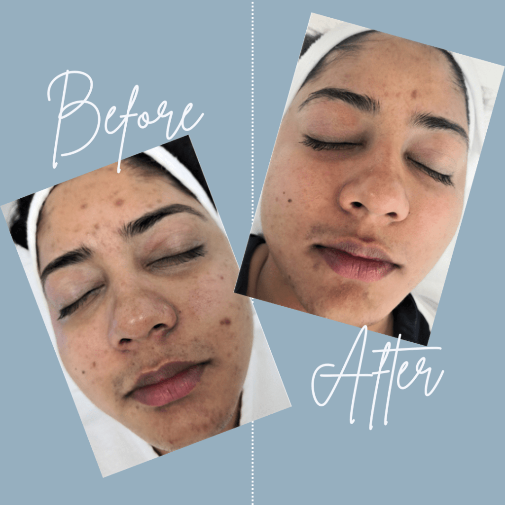 Before and after images using our Aquafirme XS medical facial treatment-image16