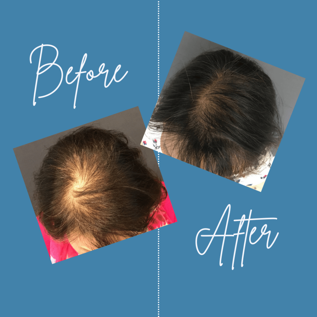 Before and after images using our Aquafirme XS hair restoration treatment