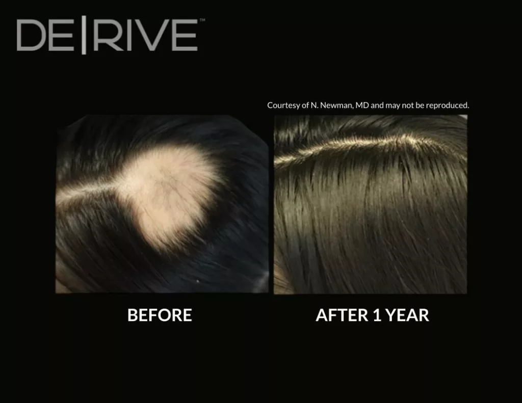 Painless hair restoration treatment before and after images. Used DE|RIVE via AquafirmeXS platform at SANTÉ Aesthetics & Wellness in Portland, Oregon. Image 6.