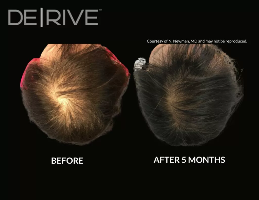 Painless hair restoration treatment before and after images. Used DE|RIVE via AquafirmeXS platform at SANTÉ Aesthetics & Wellness in Portland, Oregon. Image 7.