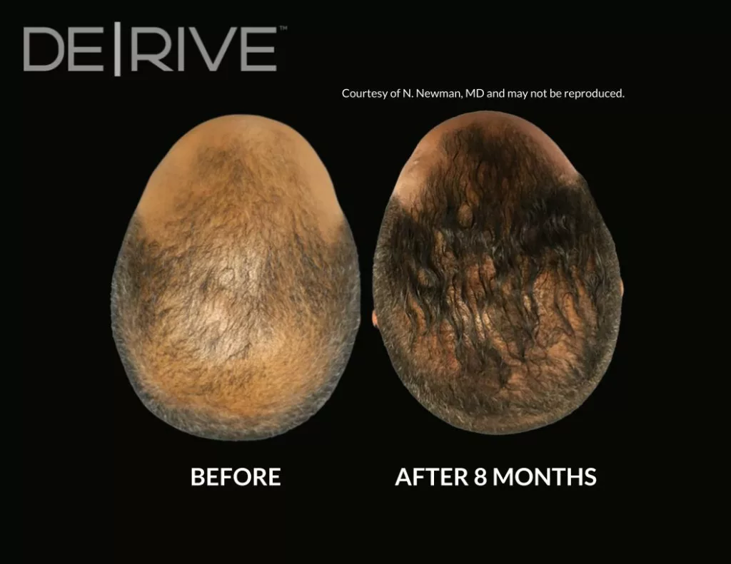 Painless hair restoration treatment before and after images. Used DE|RIVE via AquafirmeXS platform at SANTÉ Aesthetics & Wellness in Portland, Oregon. Image 5.