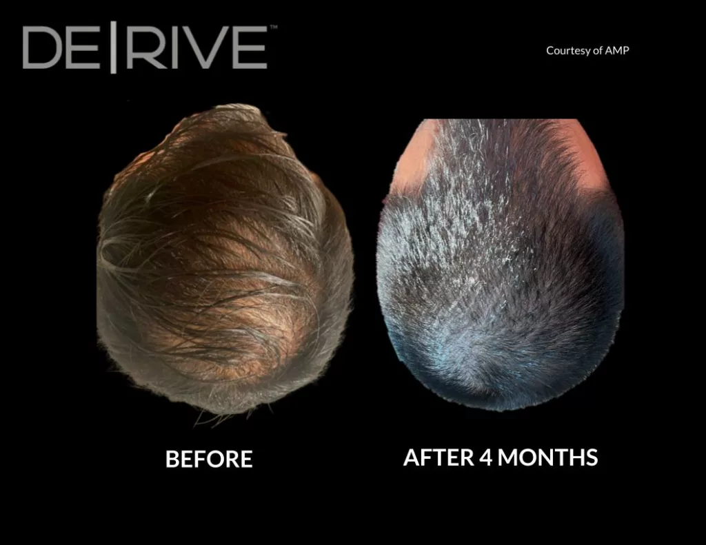 Painless hair restoration treatment before and after images. Used DE|RIVE via AquafirmeXS platform at SANTÉ Aesthetics & Wellness in Portland, Oregon. Image 4.