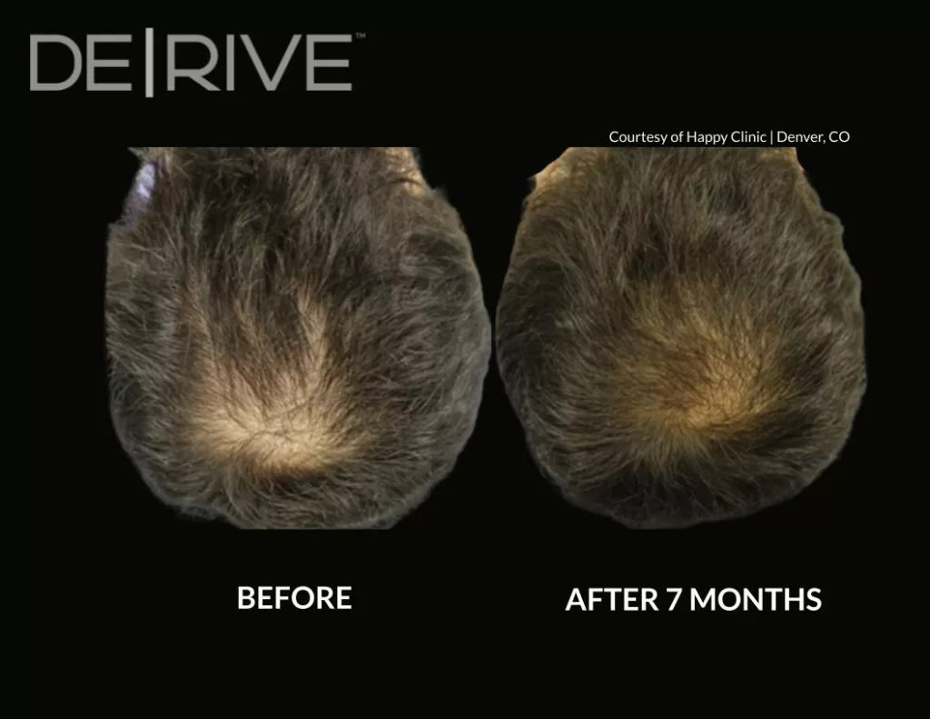 Painless hair restoration treatment before and after images. Used DE|RIVE via AquafirmeXS platform at SANTÉ Aesthetics & Wellness in Portland, Oregon. Image 3.