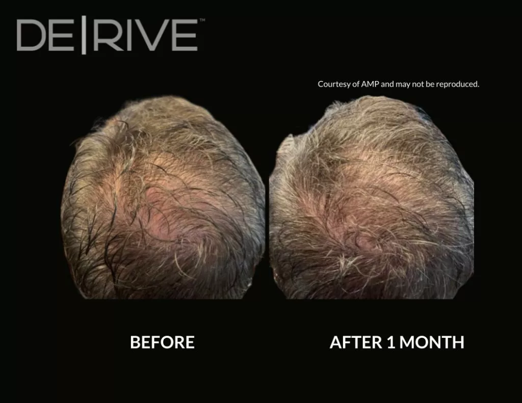 Painless hair restoration treatment before and after images. Used DE|RIVE via AquafirmeXS platform at SANTÉ Aesthetics & Wellness in Portland, Oregon. Image 2.
