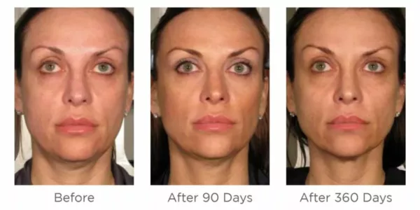 Ultherapy before and after images to 360 days. SANTÉ Aesthetics & Wellness in Portland, Oregon