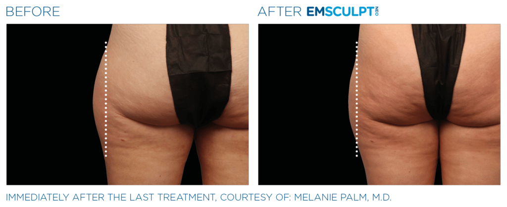 Legs treated using EMSCULPT neo at SANTÉ Aesthetics & Wellness in Portland, Oregon.