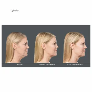 Before and after-kybella body contouring-SANTÉ Aesthetics & Wellness in Portland, Oregon