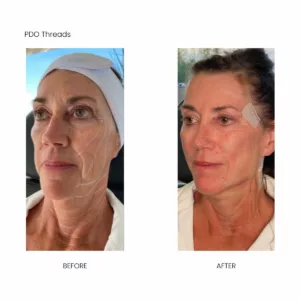 Before and after-pdo threads body contouring-SANTÉ Aesthetics & Wellness in Portland, Oregon