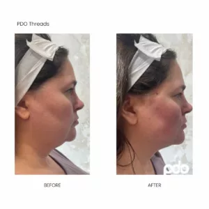 Before and after-pdo threads body contouring-SANTÉ Aesthetics & Wellness in Portland, Oregon