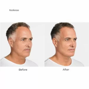 Before and after-radiesse body contouring-SANTÉ Aesthetics & Wellness in Portland, Oregon
