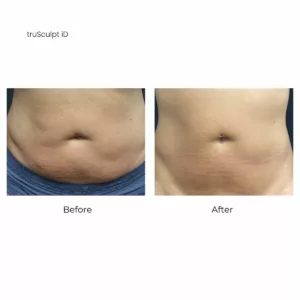 Before and after-truSculpt iD body contouring-SANTÉ Aesthetics & Wellness in Portland, Oregon