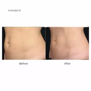 Before and after-truSculpt iD body contouring-SANTÉ Aesthetics & Wellness in Portland, Oregon