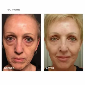 PDO Threads before and after face-SANTÉ Aesthetics & Wellness in Portland, Oregon