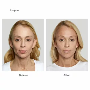 Sculptra before and after lower jaw-SANTÉ Aesthetics & Wellness in Portland, Oregon