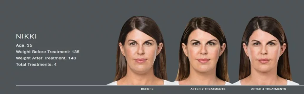 Kybella before and after images for the chin-SANTÉ Aesthetics & Wellness in Portland, Oregon