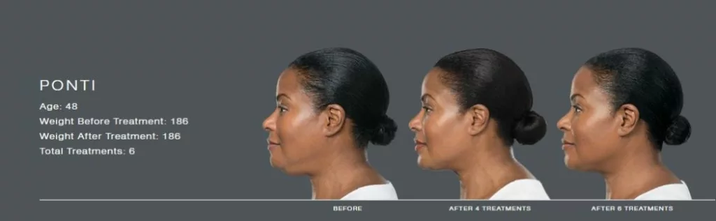 Kybella before and after images for the chin-SANTÉ Aesthetics & Wellness in Portland, Oregon
