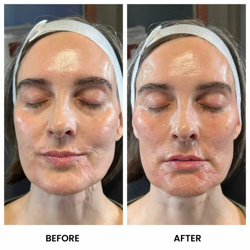 Derma PRP Before and After-Face-SANTÉ Aesthetics & Wellness in Portland, Oregon