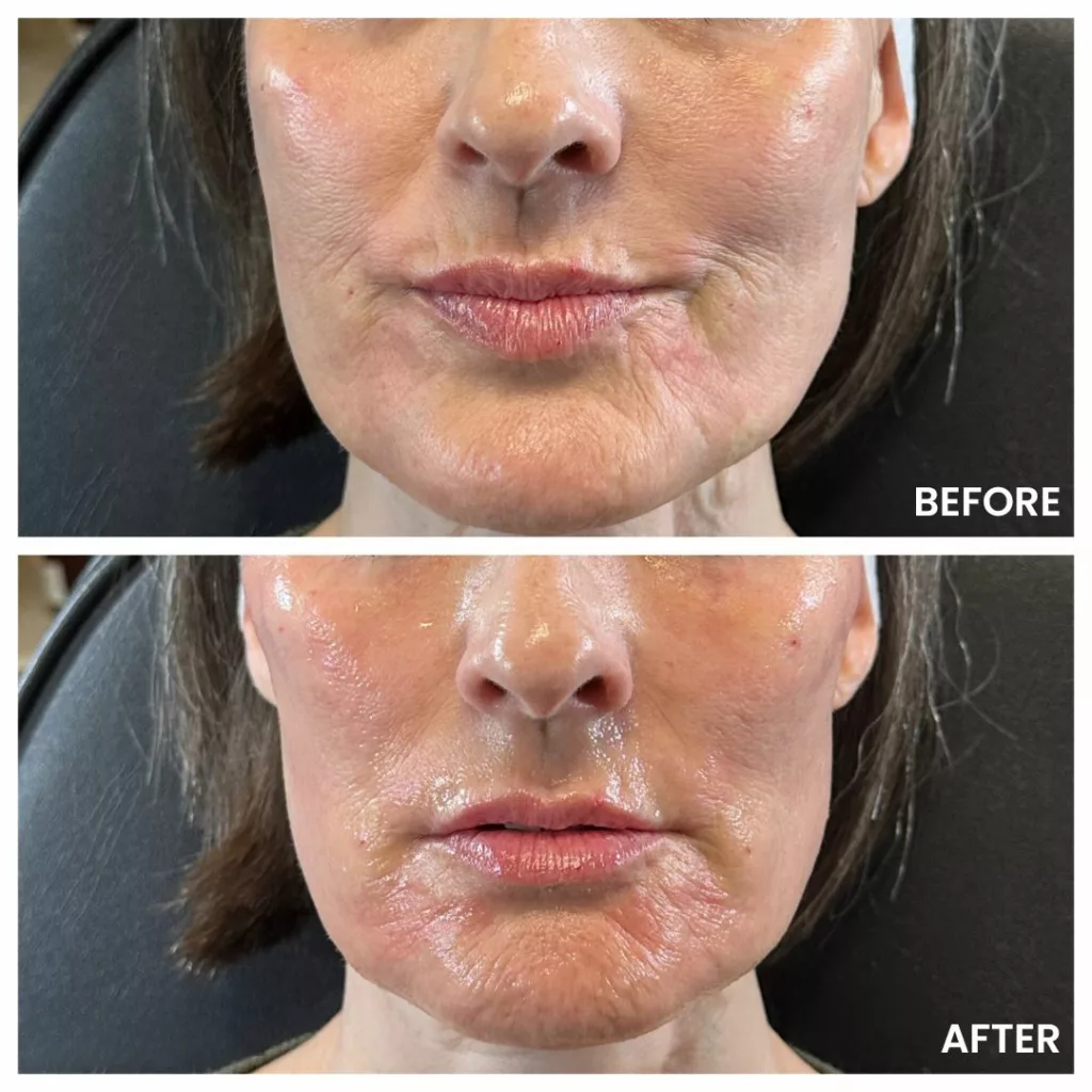 Derma PRP Before and After-Lower Face-SANTÉ Aesthetics & Wellness in Portland, Oregon