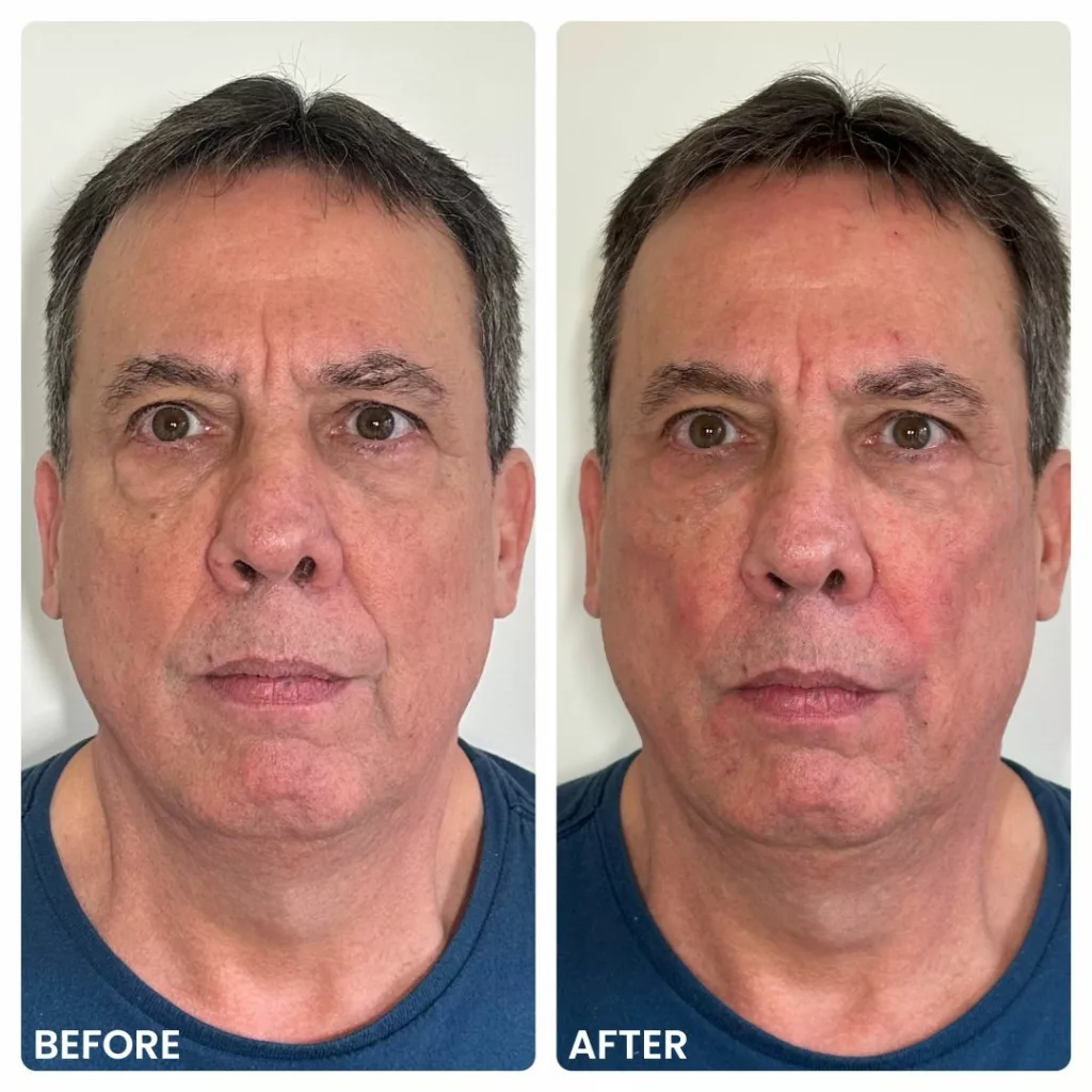 Derma PRP Before and After-Male Face-SANTÉ Aesthetics & Wellness in Portland, Oregon