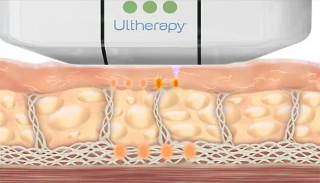 ultherapy_how_it_works